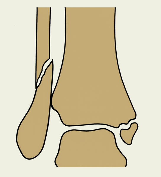  Повреждение кости в области коленного сустава