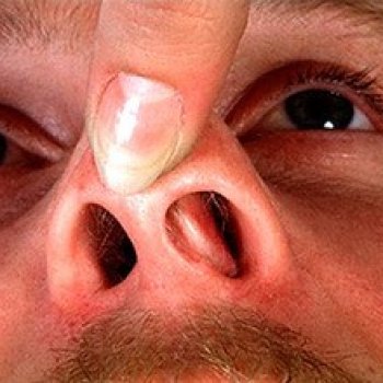 Хронический ринит часто является следствием искривление перегородки носа, которое образовалось из-за неправильного лечения перелома либо вообще его отсутствия.