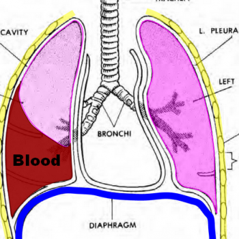 При гемотораксе происходит скопление крови в плевральной полости