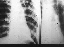 Казеозная пневмония: нетипичное течение туберкулеза