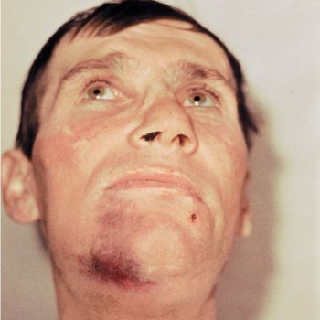 При повреждении нижней челюсти нередко образуется гематома.