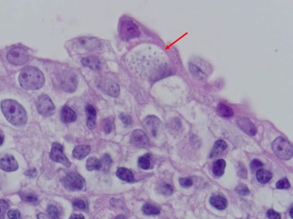Стрелка указывает на клетку хламидии