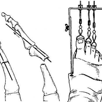 Процесс скелетного вытяжения при переломе стопы