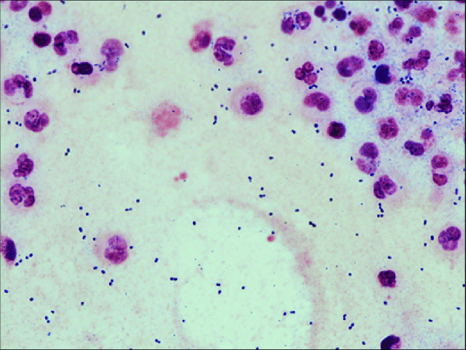 Streptococcus pneumoniae – наиболее характерный возбудитель пневмоний (в 70% случаев)