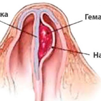При гематоме носовой перегородки может начаться абсцесс.