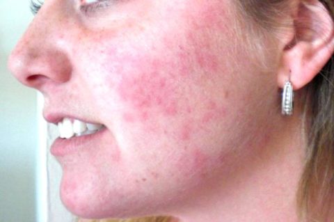Аллергия на коже от ингаляций Пульмикортом – одно из побочных явлений препарата.