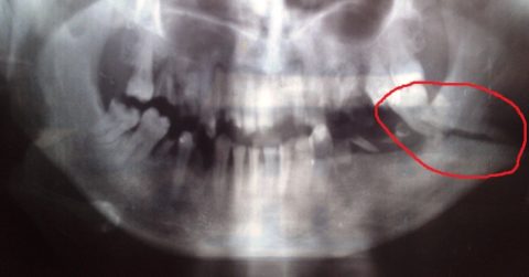 Ангулярный перелом челюсти часто возникает при аварии или ударе.
