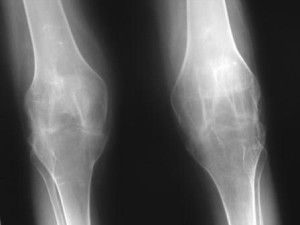 Синовэктомия колена