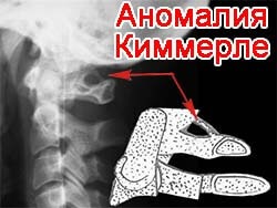 Аномалия Киммерли - рентген