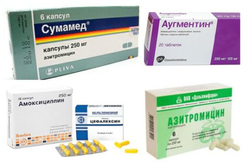 Антибиотики для лечения пневмонии