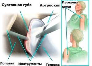 Повреждение суставной губы плечевого сустава
