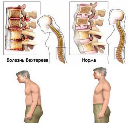 болезни спины и позвоночника названия анкилозирующий спондилоартрит