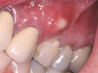 Болезни десен и зубов способствуют развитию патологии