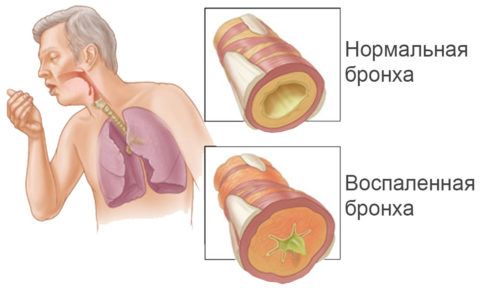 Бронхам в период воспаления на повредит дополнительная помощь в виде дыхательных упражнений