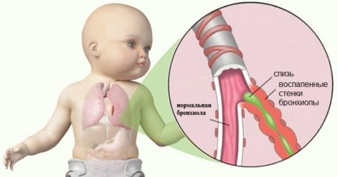 Бронхиолитом часто болеют младенцы до 7 месяцев
