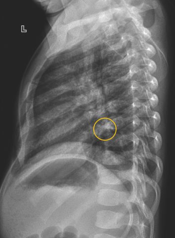 Бронхит у ребенка на рентгенограмме