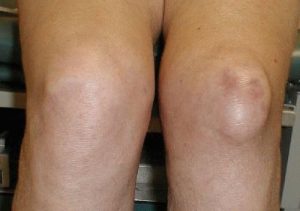 Болит коленный сустав при сгибании и разгибании