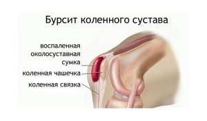 Боль в коленном суставе с внутренней стороны