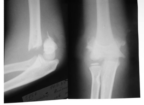 Чрезмыщелковый перелом относится к наиболее тяжелым травмам верхней конечности.