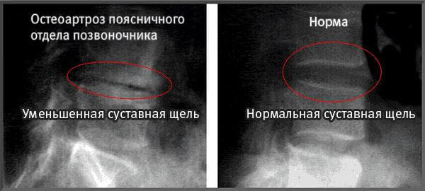 Рентген Остеоартроз позвоночника 