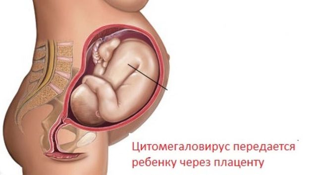 ЦМВ у беременных