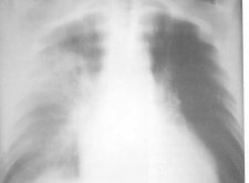 Казеозная пневмония: нетипичное течение туберкулеза