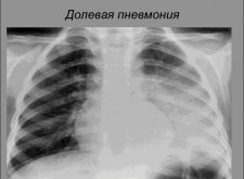 Двухсторонняя пневмония у ребенка: что нужно знать об этом заболевании