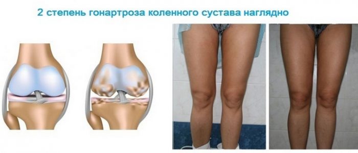 Гонартроз сустава колена