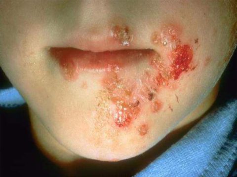 Дерматит, вызванный стафилококковой инфекцией может стать причиной распространения инфекции гематогенным путем