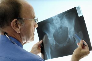 Симптомы и лечение остеоартроза тазобедренного сустава