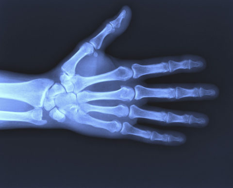 Для исключения трещин и переломов требуется рентгенологическое исследование
