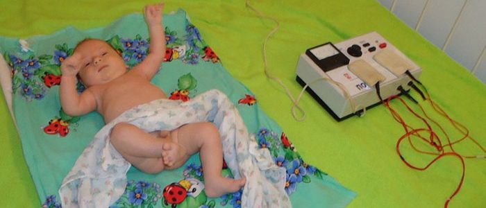 Лечение дисплазии тазобедренных суставов у детей электрофорезом
