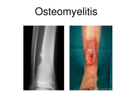Если гнойный процесс в укушенной ране распространился на костные ткани, то возникает остеомиелит.