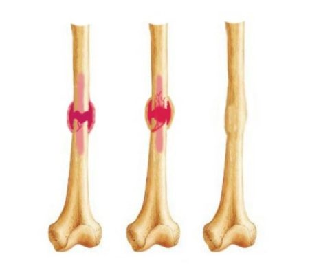 Если при укусе была повреждена кость, то в лечение добавляют специальные восстанавливающие средства и процедуры для костных тканей.
