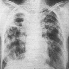 Фиброзно-кавернозный туберкулез