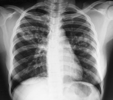 Фото больного туберкулезом легких