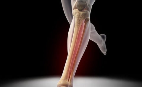 Фото: распространенные сроки полного восстановления ноги после перелома берцовой кости