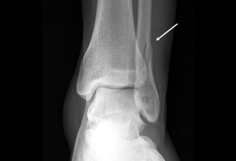 Фото: рентгеновский снимок поврежденной малоберцовой кости