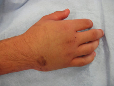 Фото: симптоматические признаки сломанного запястья руки