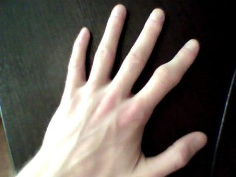 Фото: время заживления сломанного пальца руки