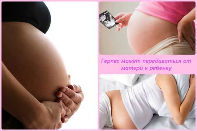 Генитальный герпес при беременности - заражение плода