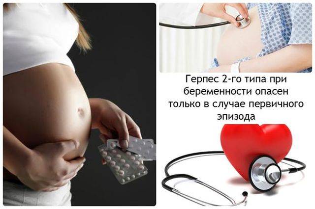 Генитальный герпес 2го типа при беременности