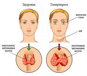 Щитовидная железа и заболевания суставов