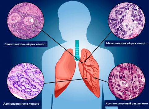 Гистологические отличия основных видов рака легких