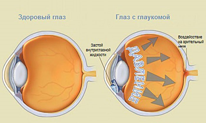 Кровоизлияние в глазу от сахарного диабета