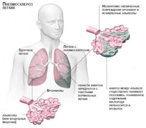 Характерные особенности пневмосклероза