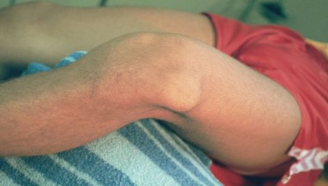 Характерные особенности сломанного колена в организме человека