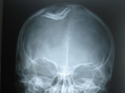 Характерные особенности вдавленного повреждения костной целостности черепа