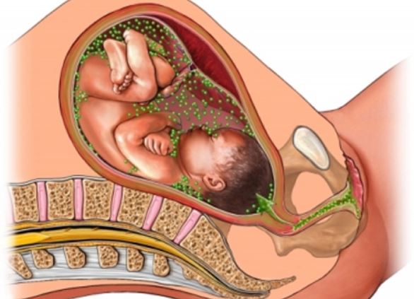 Обострение герпеса во время беременности хламидиоз