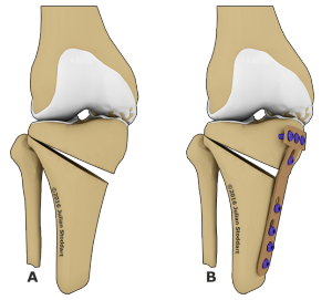 Остеотомия сустава колена